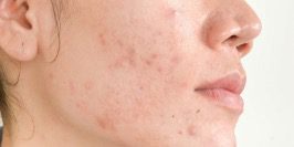 Acne Skin