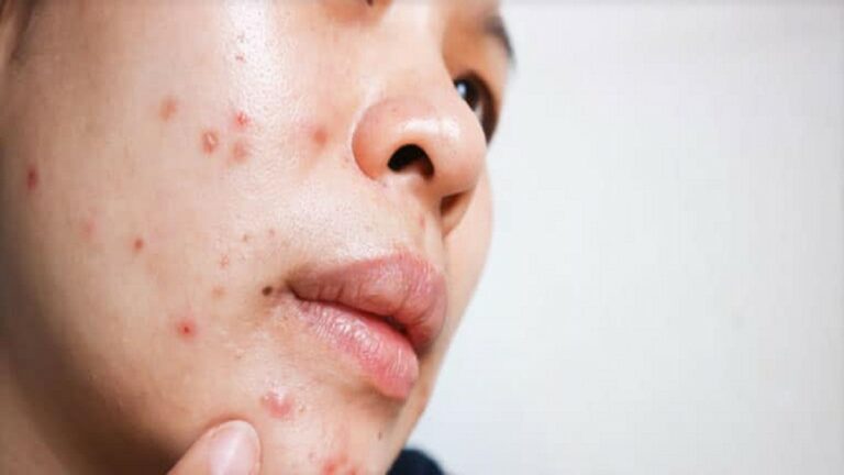 Rutinitas Perawatan Malam Hari untuk Kulit Berjerawat agar Cepat Sembuh