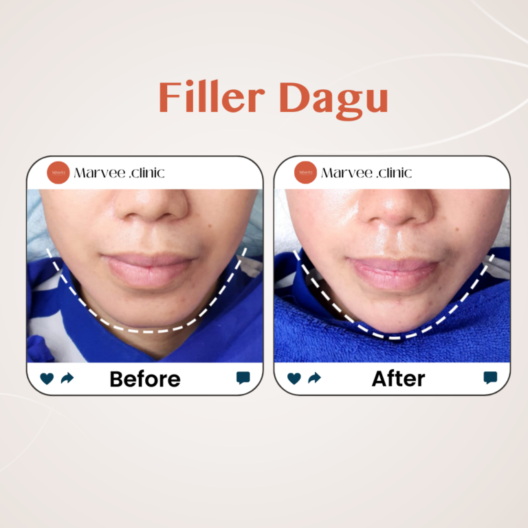 Treatment Filler Dagu: Solusi Praktis untuk Wajah Lebih Proporsional