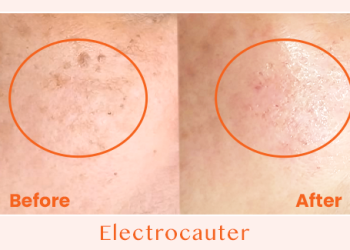 Electrocauter Before After