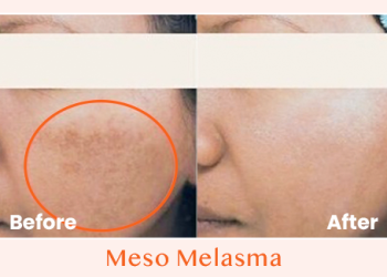 Meso Melasma Before After