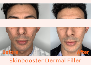 Skinbooster Dermal Filler