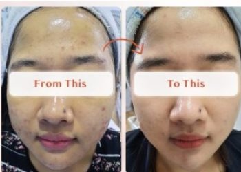 Perawatan untuk mengatasi wajah kusam dan berminyak skincare yang tepat untuk wajah kusam dan berminyak