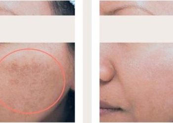 cara mengatasi melasma apakah melasma di wajah bisa dihilangkan