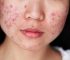acne