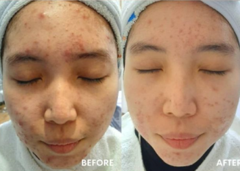 cara menghilangkan bekas jerawat perawatan untuk kulit kusam